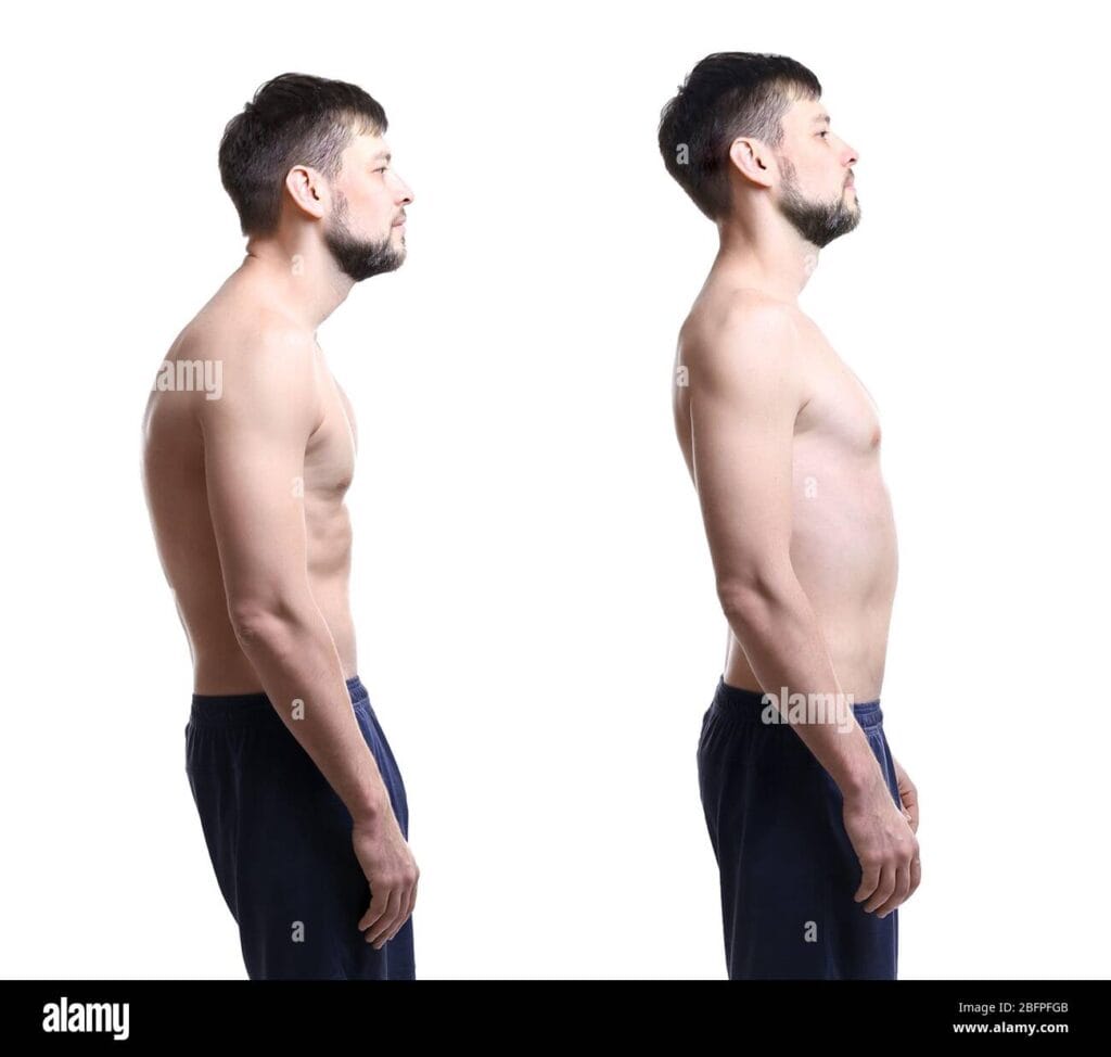 rehabilitation-concept-collage-of-man-with-poor-and-good-posture-on-white-background-2BFPFGB
